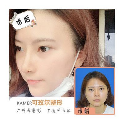 广州可玫尔整形医院张球俊做的隆鼻 广州可玫尔整形医院张球俊做的隆鼻