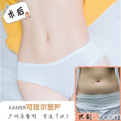 广州可玫尔整形医院<!--<i data=20240703-sp></i>-->诚做的吸脂 广州可玫尔整形医院<!--<i data=20240703-sp></i>-->诚做的吸脂