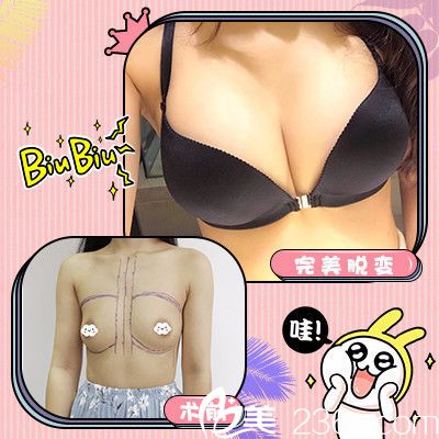 广州可玫尔医疗美容<!--<i data=20240703-sp></i>-->诚做的隆胸 广州可玫尔医疗美容<!--<i data=20240703-sp></i>-->诚做的隆胸