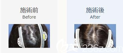 植发400株 植发400株