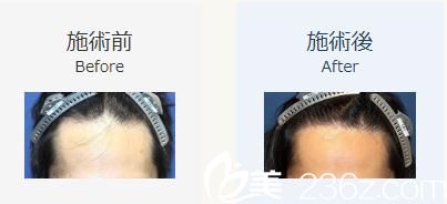 植发1000株 植发1000株