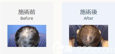 植发1500株 植发1500株