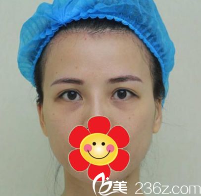 呼和浩特紫洁整形去眼袋前 呼和浩特紫洁整形去眼袋前