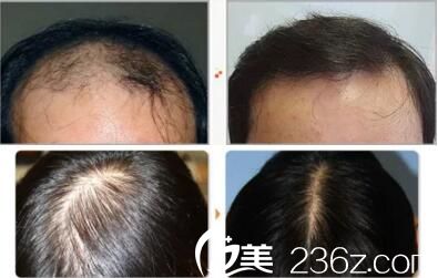 毛发移植真人案例前后效果对比 毛发移植真人案例前后效果对比