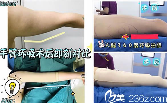 李国明手臂环吸术后即刻对比效果及大腿360度环吸前后对比照