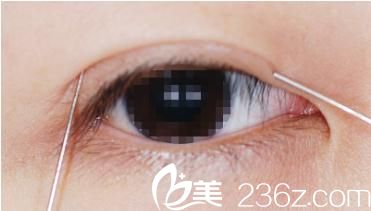 埋线术前 埋线术前