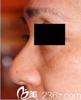 隆鼻术前 隆鼻术前
