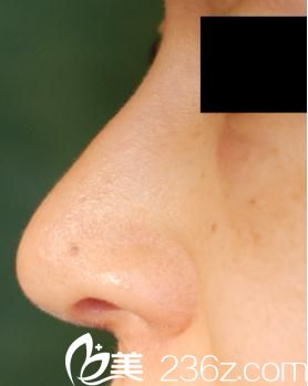 隆鼻术后