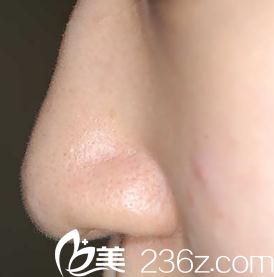 鼻尖形成术前 鼻尖形成术前