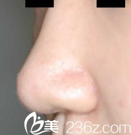 鼻尖形成术后 鼻尖形成术后