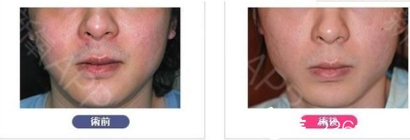 面部轮廓整形削下巴 面部轮廓整形削下巴