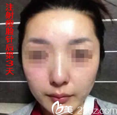 我在运城华美打瘦脸后第3天照片