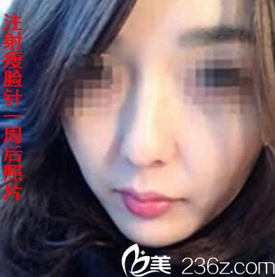 我在运城华美注射瘦脸后一周照片