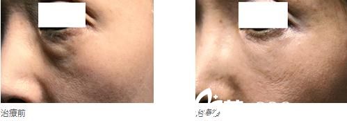眼部高见式玻尿酸注射