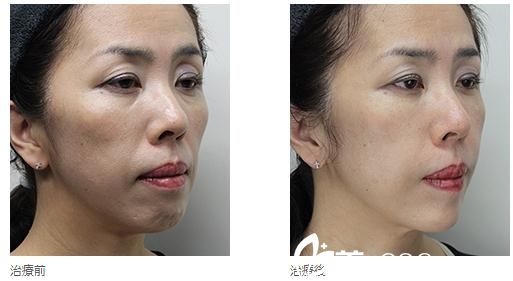 全脸高见式玻尿酸注射