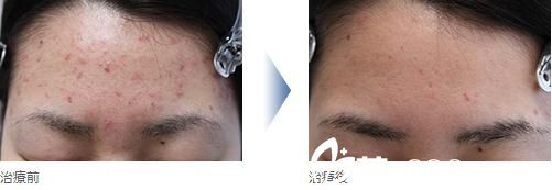 额头粉刺治疗