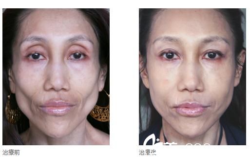 高见式玻尿酸注入 高见式玻尿酸注入