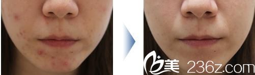 面部下部粉刺治疗 面部下部粉刺治疗