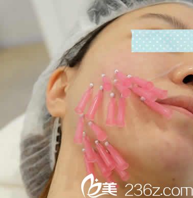 我在聊城韩美整形做面部线雕提升手术中