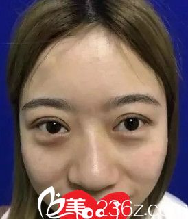 术前鼻子塌平 术前鼻子塌平