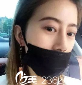 术后7天鼻子拆线后微肿 术后7天鼻子拆线后微肿