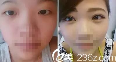 荆门和丽双眼皮案例 荆门和丽双眼皮案例