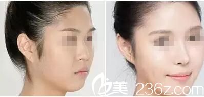 荆门和丽隆鼻案例 荆门和丽隆鼻案例