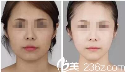 荆门和丽瘦脸案例 荆门和丽瘦脸案例