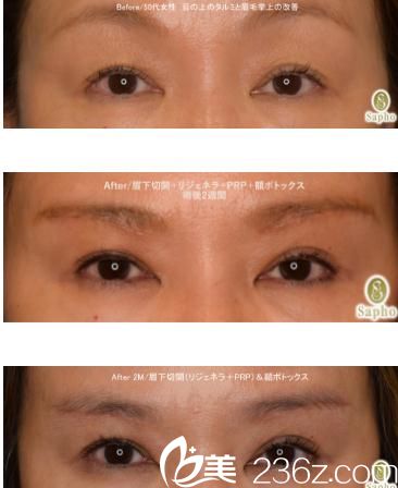 眉下切开术 眉下切开术