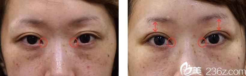 埋设法双眼皮 埋设法双眼皮