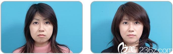 面部提升 面部提升