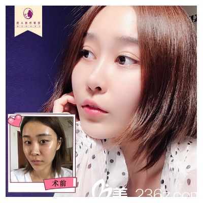 广州佳人整形医院王<!--<i data=20240703-sp></i>-->双眼皮隆鼻案例