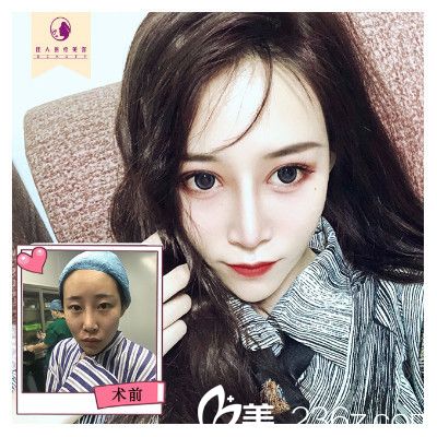 广州佳人整形医院王<!--<i data=20240703-sp></i>-->做的隆鼻案例