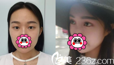 <!--<i data=20240703-sp></li>
<li><i data=20240703-sp></i>-->韩式双眼皮案例