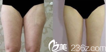 <!--<i data=20240703-sp></li>
<li><i data=20240703-sp></i>-->腿部吸脂案例