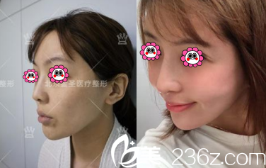 <!--<i data=20240703-sp></li>
<li><i data=20240703-sp></i>-->肋软骨隆鼻案例