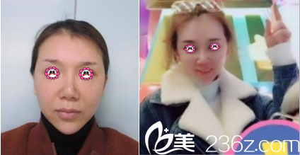 <!--<i data=20240703-sp></li>
<li><i data=20240703-sp></i>-->埋线提升案例