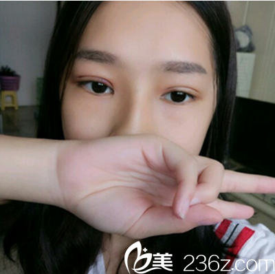 乐山达芬奇双眼皮术后即刻