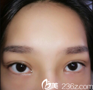 平行双眼皮术后半个月恢复情况