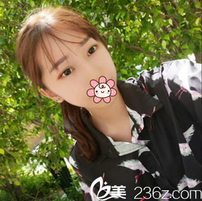 埋线双眼皮术后一个月恢复效果