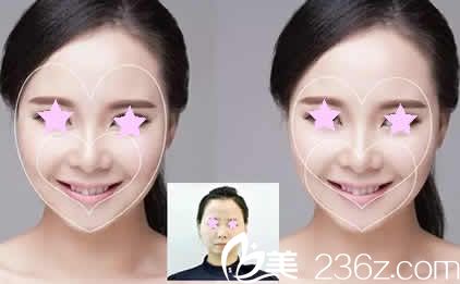 太原华美整形特邀医生吕睿紘双心脸案例图