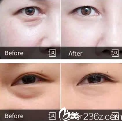 太原华美整形吕睿紘无痕祛眼袋前后效果对比图