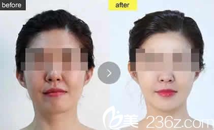 太原华美整形医生吕睿紘面部埋线提升案例图