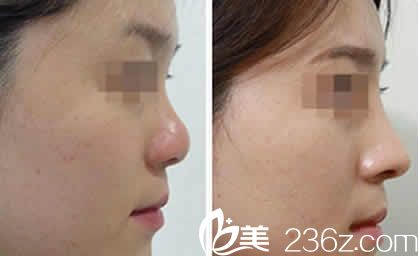 吕睿紘博士韩式4D隆鼻案例效果图
