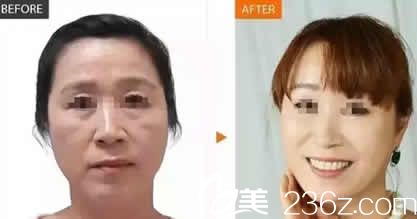 吕睿紘微创面部注射年轻化效果图