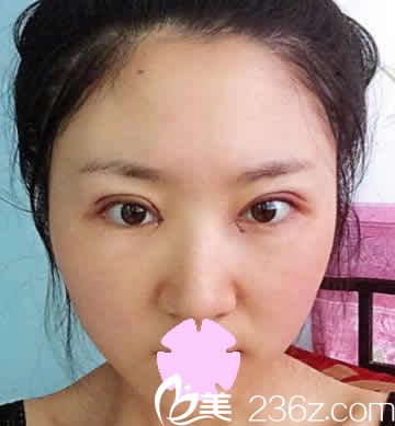 我在晋城韩尚医美做全切双皮加开眼角后第3天照片