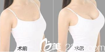 东营艺美假体隆胸真人<span style=