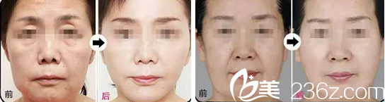 整形除皱案例 整形除皱案例