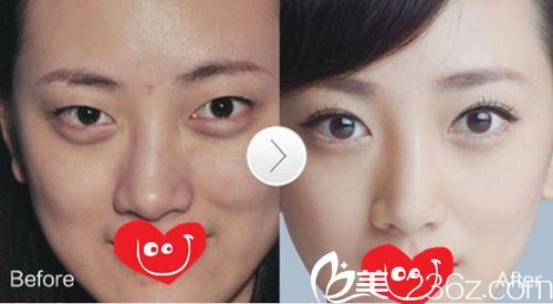 邯郸京美双眼皮案例 邯郸京美双眼皮案例