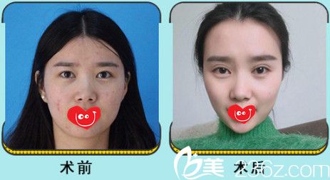 京美瘦脸案例 京美瘦脸案例
